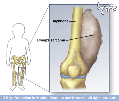 سارکوم یوئینگ، تومور سرطانی نوجوانان