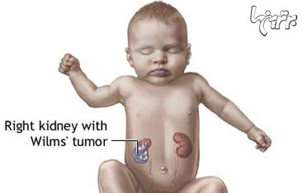 تومور سرطانی ویلمز یا نفروبلاستوما چیست؟