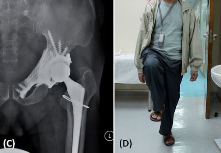 یکی دیگر از معجزات پزشکی پرینتر 3 بعدی