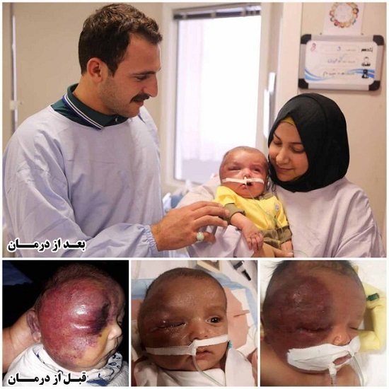 سندروم کُشنده کودک عراقی در مشهد درمان شد