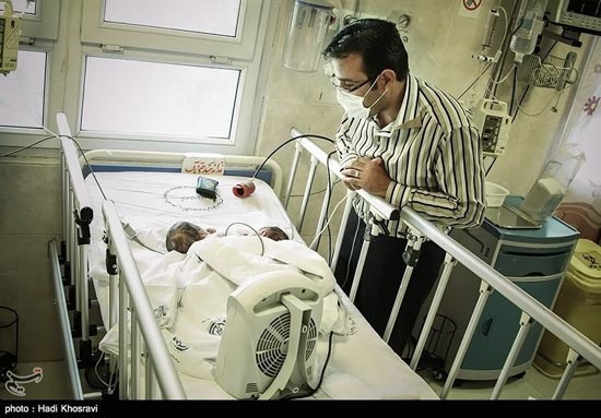 تولد دو قلوهای به هم چسبیده در شیراز