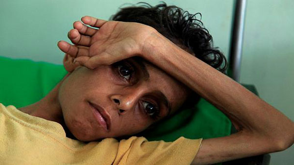 تصاویر جانگداز از کودک ۱۰ ساله و ۸ کیلویی یمنی