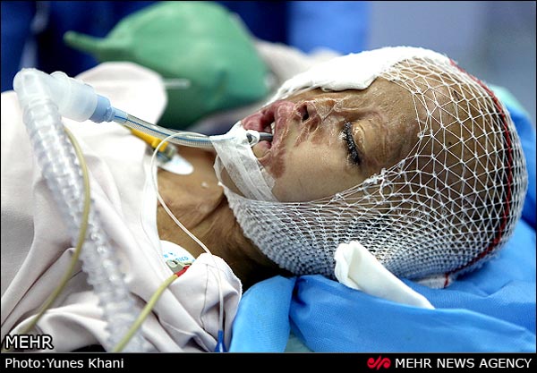 تصاویر جراحی‌ کودک قربانی اسیدپاشی(16+)