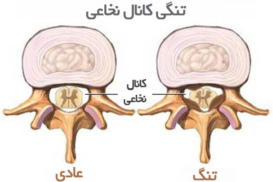 تنگی کانال نخاع؛ علل، علائم و راه‌های درمان آن