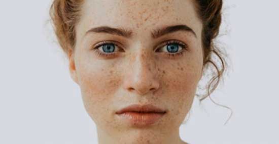 درمان موثر لک‌های پوستی با چند ترکیب ساده