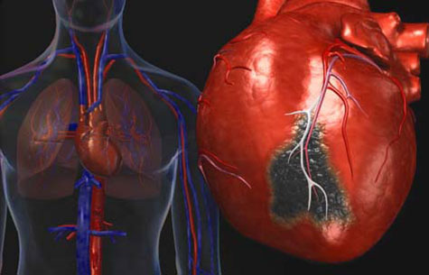 حمله قلبی، سکته مغزی یا آنژین؟ علائم را بشناسید