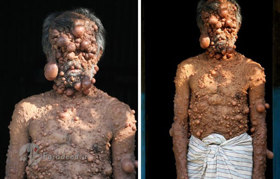 تومورهای حبابی مرد بنگلادشی (16+)