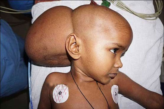 عکس: تومور 3 کیلویی در سر یک دختر!