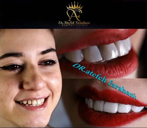 فرق کامپوزیت دندان با لمینت سرامیکی چیست؟ کدام یک بهتر است؟ 