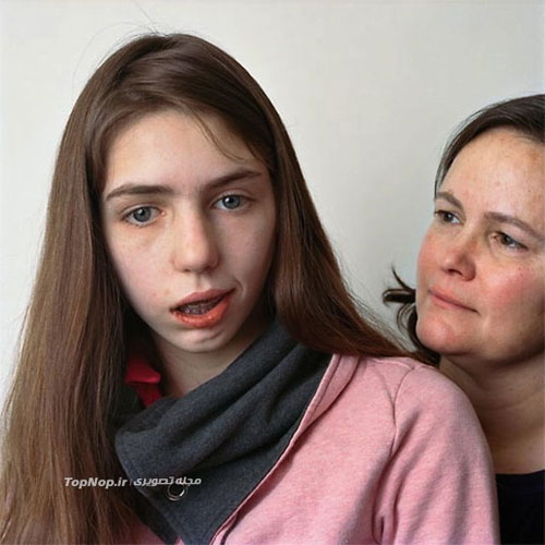 پرتره‌ای از افراد مبتلا به فلج صورت +عکس