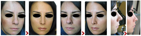 جراحی زیبایی بینی، پلک، گونه، چانه، گوش و صورت با دکتر سوران ایوبیان