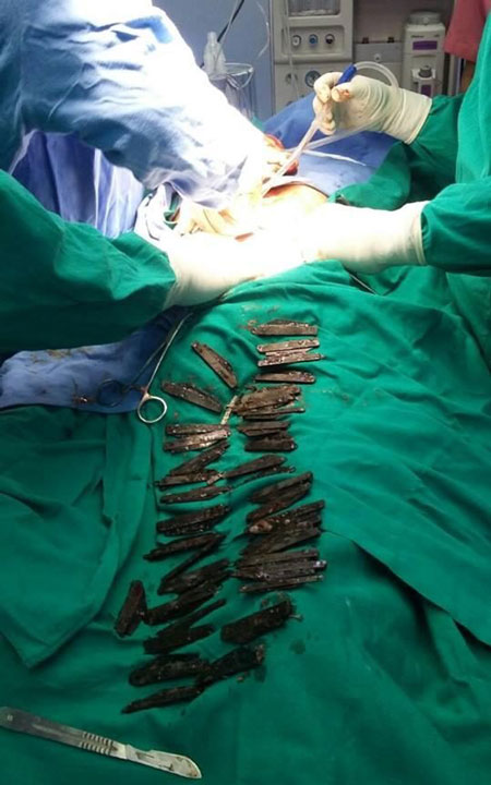 40 چاقوی فلزی از معده بیمار هندی خارج شد