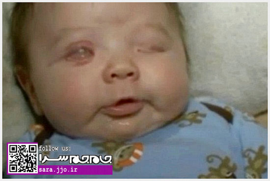 عکس: تولد نوزاد بدون چشم در آمریکا (14+)