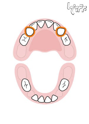 ترتیب رشد دندان های کودک