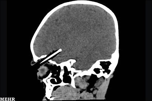 تصویر یک مداد در داخل مغز کودک 2 ساله!