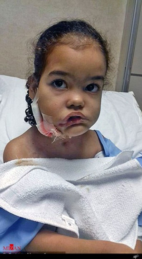 خارج کردن تومور 2 کیلویی از صورت دختربچه برزیلی