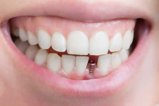 مراحل ایمپلنت دندان و مدت زمان انجام آن