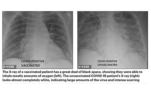 تصویر ریه مبتلایان به کرونا، قبل و بعد از واکسن