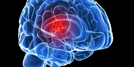 علامت هایی که از تومور مغزی خبر می دهند
