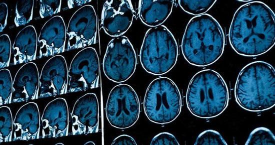 تشخیص افسردگی با تصویر MRI مغز