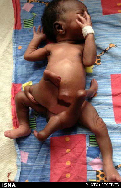 عکس: تولد نوزادی با 8 دست و پا!