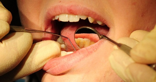 جلوگیری از پوسیدگی دندان با کامپوزیت‌ ضدِ باکتری