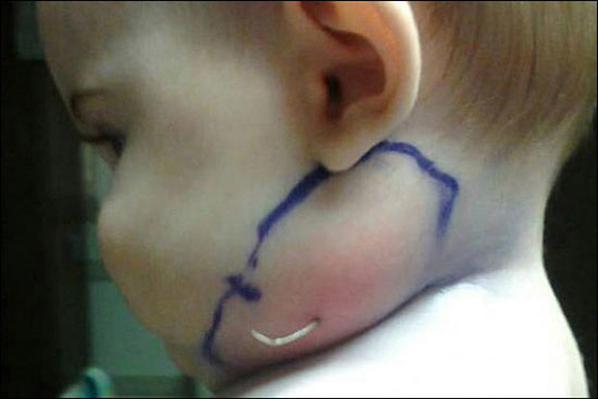 رشد پـَر در گردن یک کودک 7 ماهه! +عکس