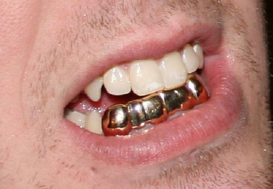 لمینت طلا دندان چیست و هزینه آن چقدر است؟