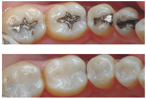 انواع کامپوزیت دندان و کاربرد آن + ویژگی بهترین نوع