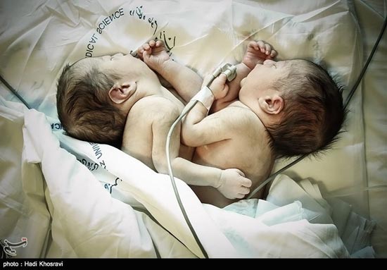 تولد دو قلوهای به هم چسبیده در شیراز