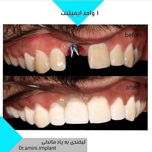 قيمت ايمپلنت - دکتر مهران امینی