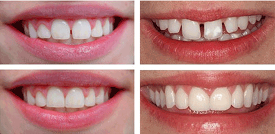 بستن فاصله بین دندان ها + پرکردن فاصله با روش های ارتودنسی، کامپوزیت و ...