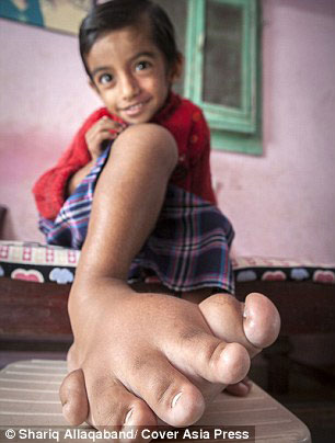 بیماری عجیب پسر 4 ساله هندی +عکس
