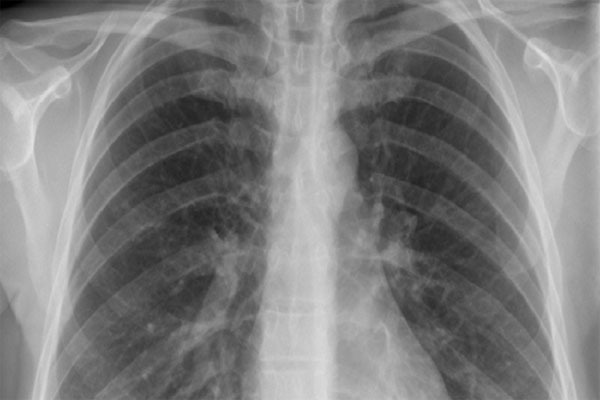 تشخیص بیماری از صدای تنفس بیمار